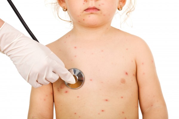 Little kid with small pox at the physical exam
