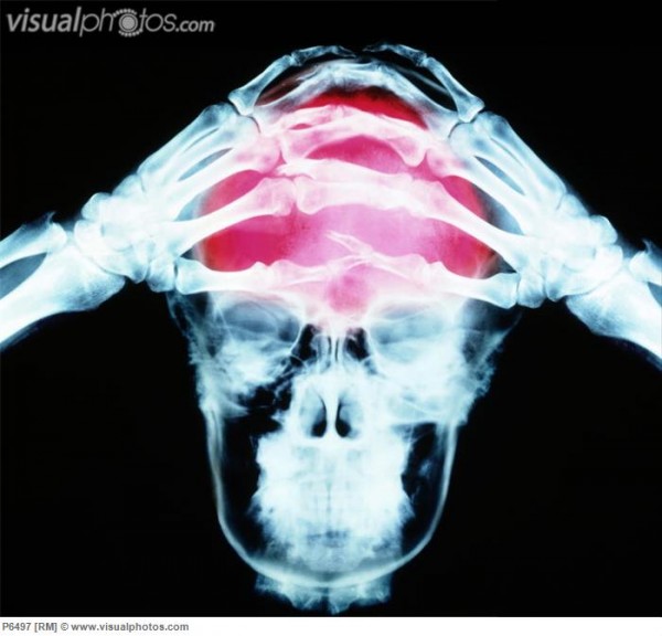 Headache. (Headache. Colored X-ray of a human skull. The pink area represents the pain of headache or migraine. Headache is one of the most common types of pain. The pain does not come from the brain, which contains no s